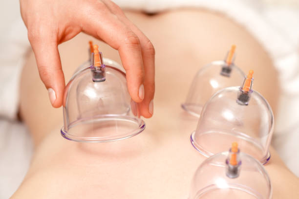 Why Therapeutic Massage Therapy at Revival Airdrie Could Be Your Solution to Neck Pain 2 Cupping therapy Vacuum cups of medical cupping therapy on woman back, close up, chinese medicine, therapeutic massage
