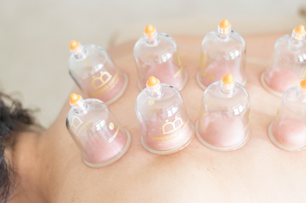 cupping therapy